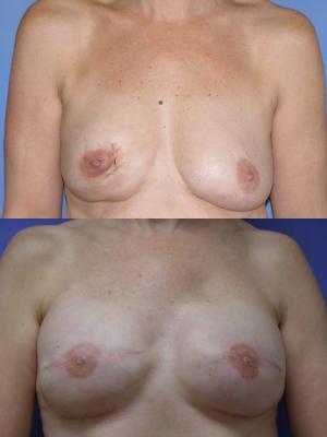 breast-reconstruction-and-tissue-expanders-p48.jpg