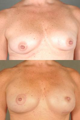 breast-reconstruction-and-tissue-expanders-p49.jpg