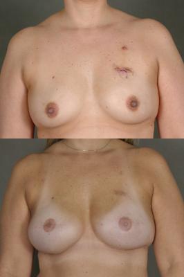 breast-reconstruction-and-tissue-expanders-p5.jpg