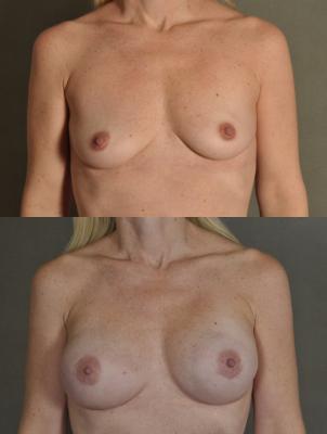 breast-reconstruction-and-tissue-expanders-p50.jpg