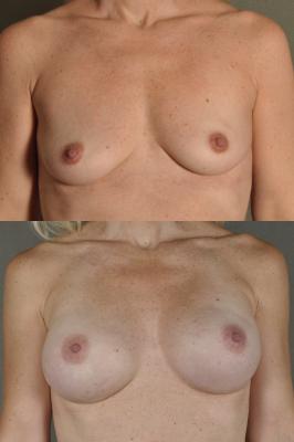 breast-reconstruction-and-tissue-expanders-p50_TVtR6PH.jpg