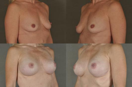 breast-reconstruction-and-tissue-expanders-p50_ZJeaoiK.jpg