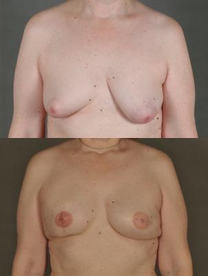 breast-reconstruction-and-tissue-expanders-p51.jpg