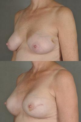 breast-reconstruction-and-tissue-expanders-p52_TGCzG7u.jpg