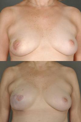 breast-reconstruction-and-tissue-expanders-p54.jpg