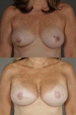 breast-reconstruction-and-tissue-expanders-p6.jpg