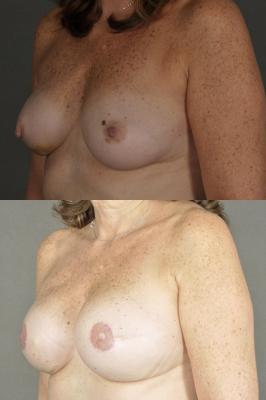 breast-reconstruction-and-tissue-expanders-p6_QctK73j.jpg