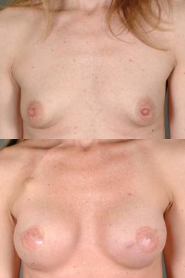 breast-reconstruction-and-tissue-expanders-p7.jpg