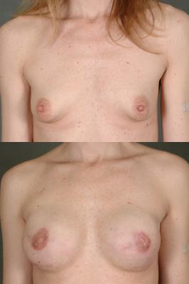 breast-reconstruction-and-tissue-expanders-p7_jDG5Mtd.jpg