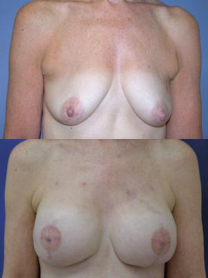 breast-reconstruction-and-tissue-expanders-p9.jpg