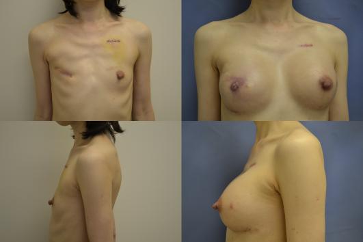 breast-reconstruction-breast-implant-g4_4UJYU6K.jpg