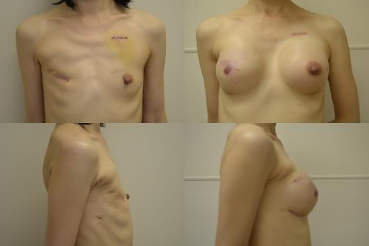breast-reconstruction-breast-implant-g4_qYo7NWE.jpg