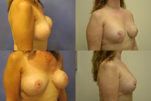 breast-reconstruction-breast-implant-revision-g4.jpg