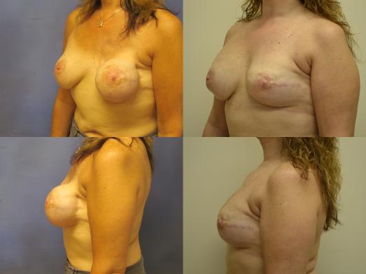 breast-reconstruction-breast-implant-revision-g4_iGOR4FD.jpg