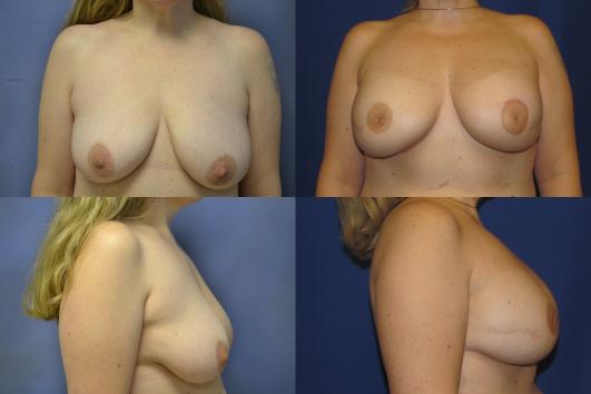 breast-reconstruction-breast-implants-g8_sY1WPQC.jpg