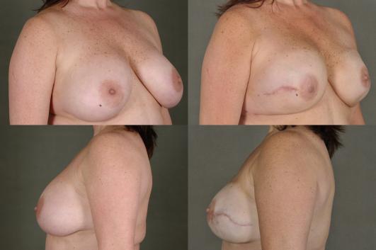 breast-reconstruction-breast-reconstruction-g7.jpg