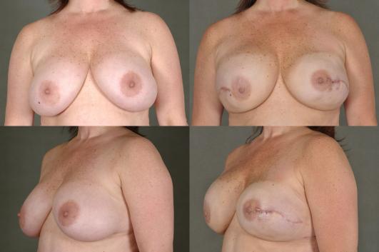 breast-reconstruction-breast-reconstruction-g7_nCpGy2H.jpg