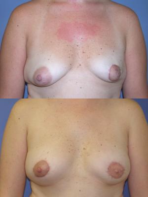 breast-reconstruction-p1.jpg