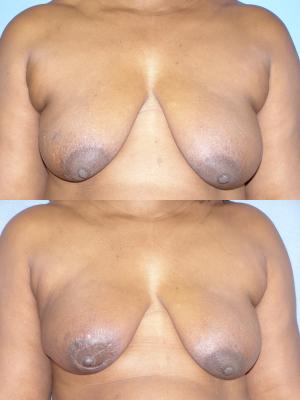 breast-reconstruction-p10_mx5PzfL.jpg