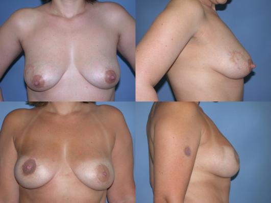 breast-reconstruction-tram-p2.jpg