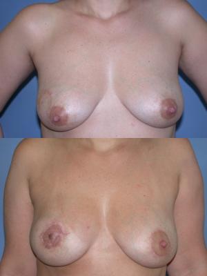 breast-reconstruction-tram-p2_btjAn8o.jpg