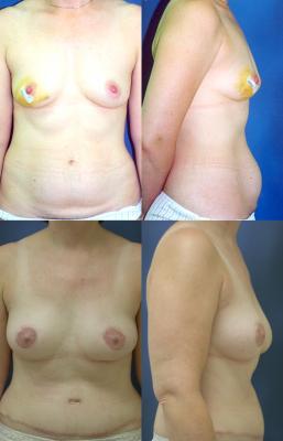 breast-reconstruction-tram.jpg