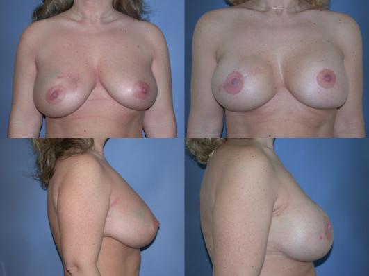 breast-reconstruction-tummy-tuck-and-liposuct-p13.jpg