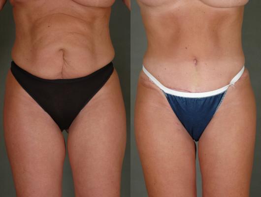 breast-reconstruction-tummy-tuck-and-liposuct-p13_gV713Ir.jpg