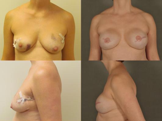 breast-reconstruction-with-implants-g1_sCEw5J0.jpg