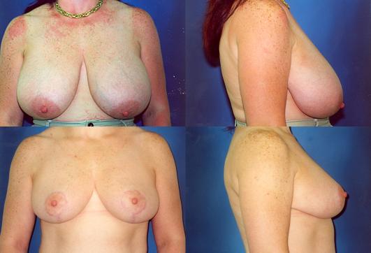 breast-reduction-1.jpg