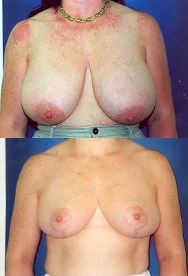 breast-reduction-1_vID8MNh.jpg