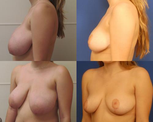 breast-reduction-and-breast-lift-g5_bdGcRD3.jpg