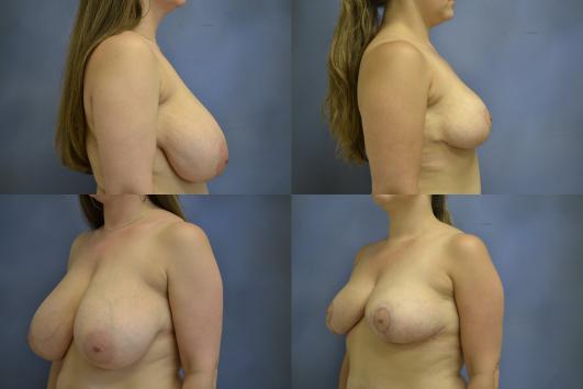 breast-reduction-and-breast-lift-g6.jpg