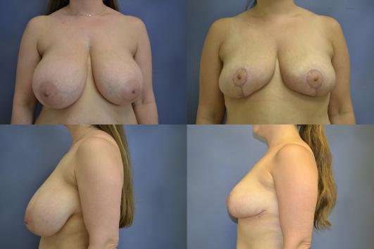 breast-reduction-and-breast-lift-g6_2zThdwT.jpg