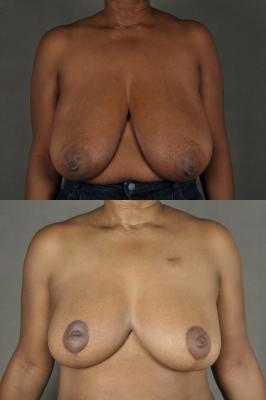 breast-reduction-and-oncoplastic-reduction-p1.jpg