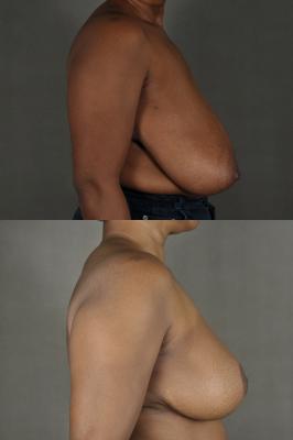 breast-reduction-and-oncoplastic-reduction-p1_RPSMO2U.jpg