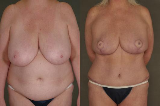 breast-reduction-and-tummy-tuck-p1_dJRh6wz.jpg