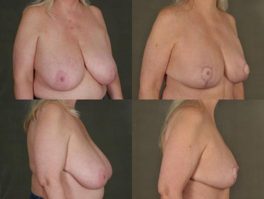 breast-reduction-and-tummy-tuck-p1_itY8Ib1.jpg