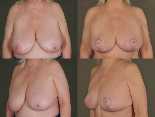 breast-reduction-and-tummy-tuck-p1_reY9aHR.jpg