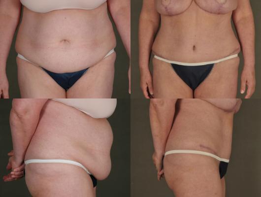 breast-reduction-and-tummy-tuck-p1_ucvpXsj.jpg