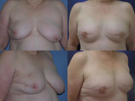 breast-reduction-and-tummy-tuck-p8_FTwZFZh.jpg