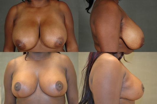 breast-reduction-p1.jpg