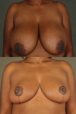 breast-reduction-p10.jpg