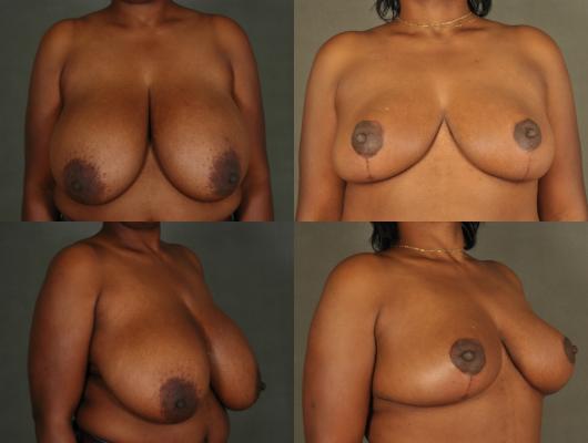 breast-reduction-p10_lvY0hoZ.jpg