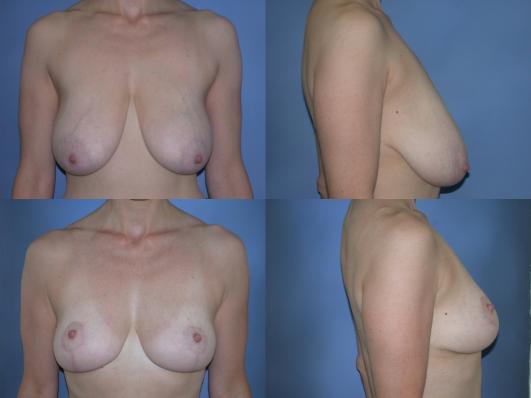 breast-reduction-p11.jpg