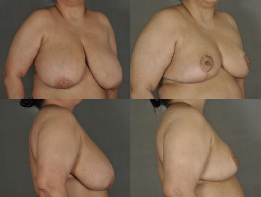 breast-reduction-p12_sAR9h5F.jpg