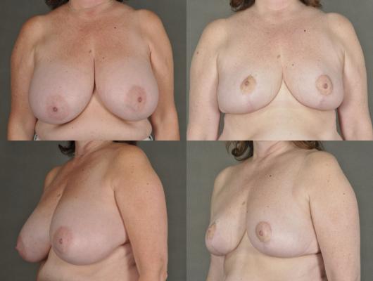 breast-reduction-p16.jpg