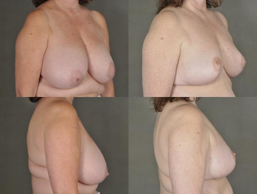 breast-reduction-p16_N0kOvIC.jpg