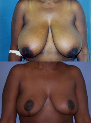 breast-reduction-p17_d0s5RrH.jpg