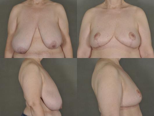 breast-reduction-p18.jpg